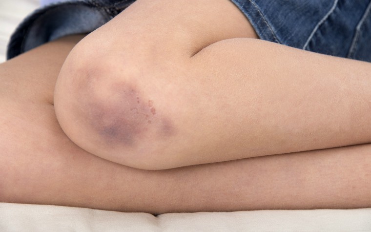 Girl with a bruised knee.